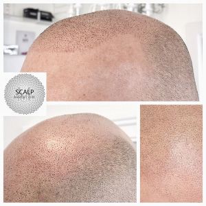 Scar, Scalp, Panda treatment